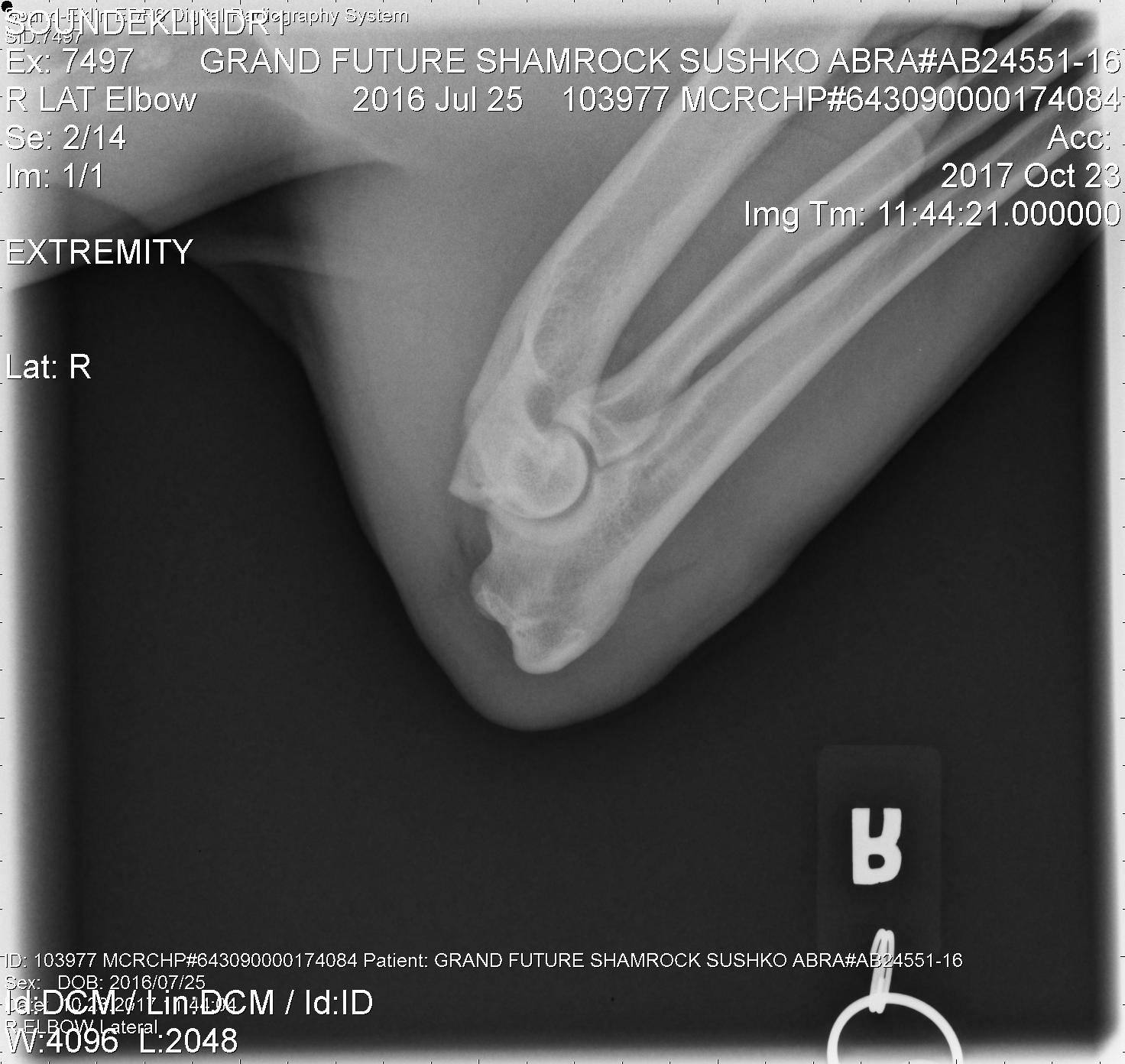 Right Elbow Radiograph